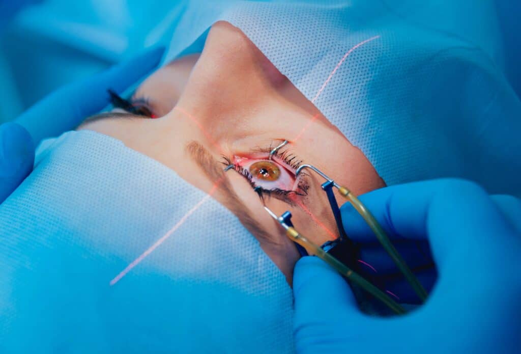 Does Medicare Cover Cataract Surgery?